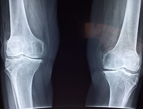 Lean Six Sigma Application in Osteo and Rheumatoid Arthritis
